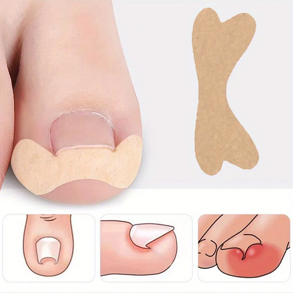 60Pcs Ingrown Toenail Strips Breathable Adhesive Toenail Stickers Patches