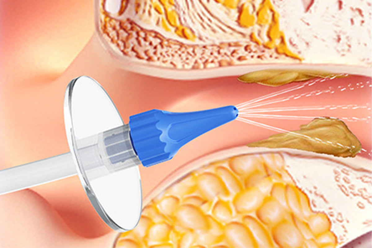 11 Ear Tips Ear Wax Removal Manual Ear Irrigation Flushing System Ear Cleaner