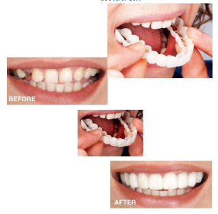 Instant Smile Enhancer Reusable Flexible Teeth Covers for Gaps Yellow Teeth