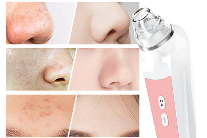 Blackhead Remover Tools with 6 Replacement Suction Heads Men and Women Pore Vacuum