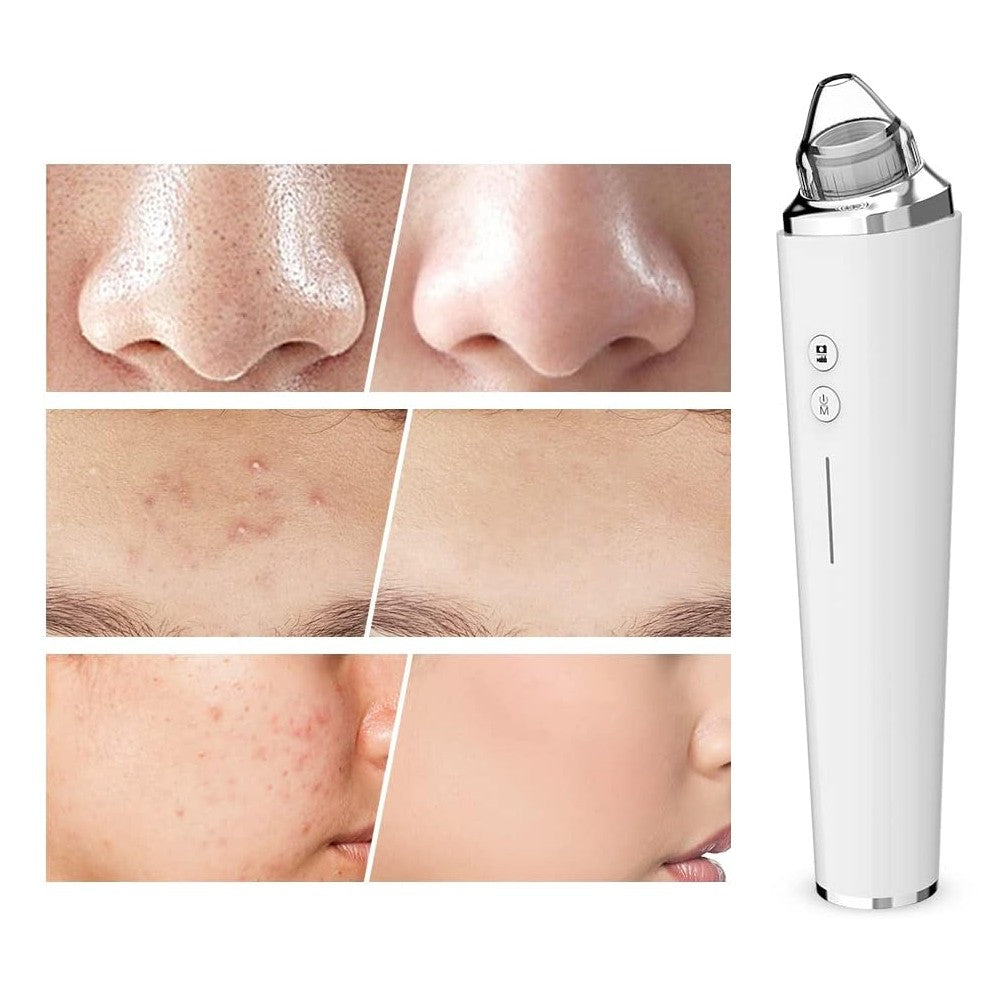 Blackhead Remover Pore Vacuum Visual Facial Pore Cleanser with 6 Suction Heads White