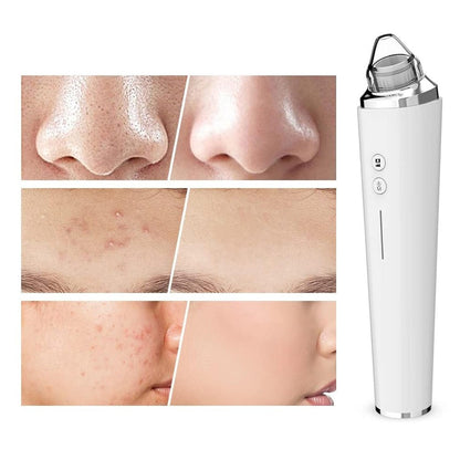 Blackhead Remover Pore Vacuum Visual Facial Pore Cleanser with 6 Suction Heads White